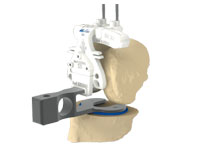 MyKnee LBS is now available! The FIRST Patient Matched Cutting Blocks with integrated LIGAMENT BALANCING SYSTEM!